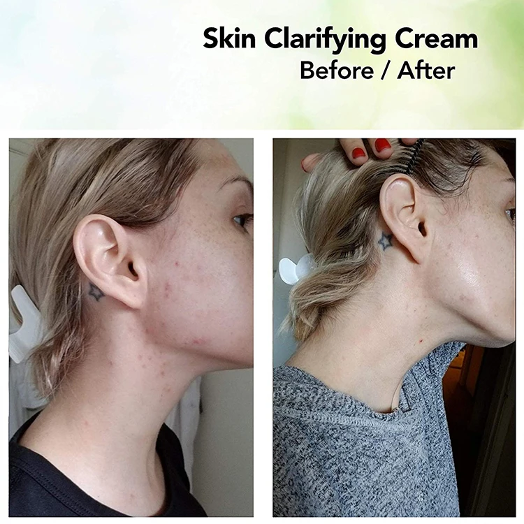 acid for cystic acne