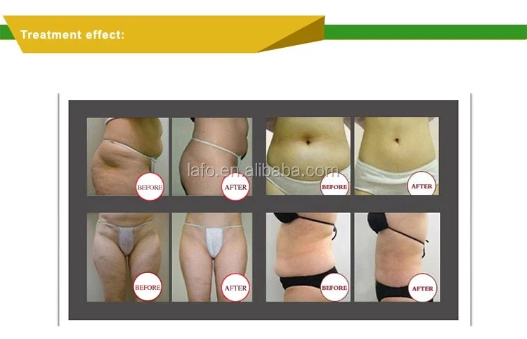 5 in 1 Infrared Laser Vacuum Rf roller body slimming machine skin tighten weight loss face lifting CE approved