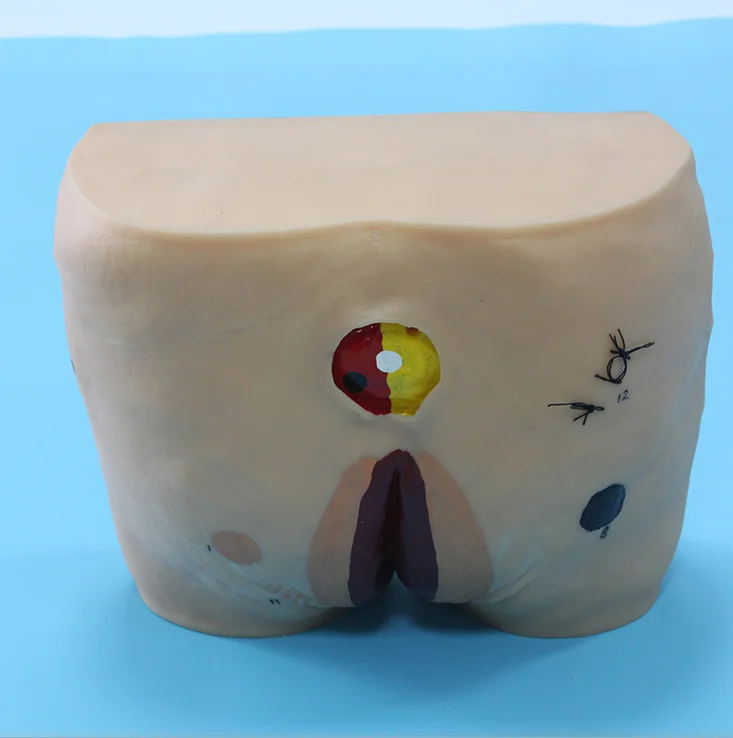 Advanced Decubitus Ulcer Care Simulator Model Decubitus Wound Care Model Buy Decubitus Ulcer