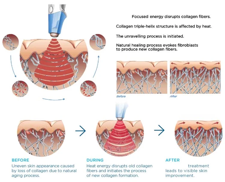 Professional 2 in 1 RF Radio Frequency Skin Tightening Equipment Body Slimming Machine