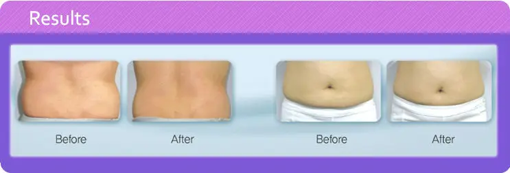 ultra sound cavitation liposlim_result