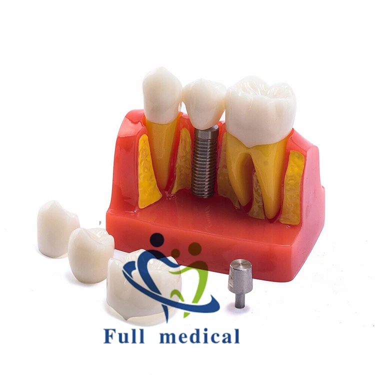 Full Medical Dental Implant Model 4 Times Dentist Model - Buy Dental ...