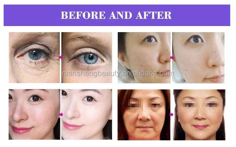 before after
