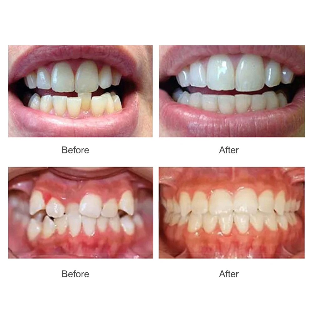Three-Stage High Quality Case Retainers Straightening Dental Appliance Teeth Trainer Alignment Braces For Tooth Orthodontic.jpg