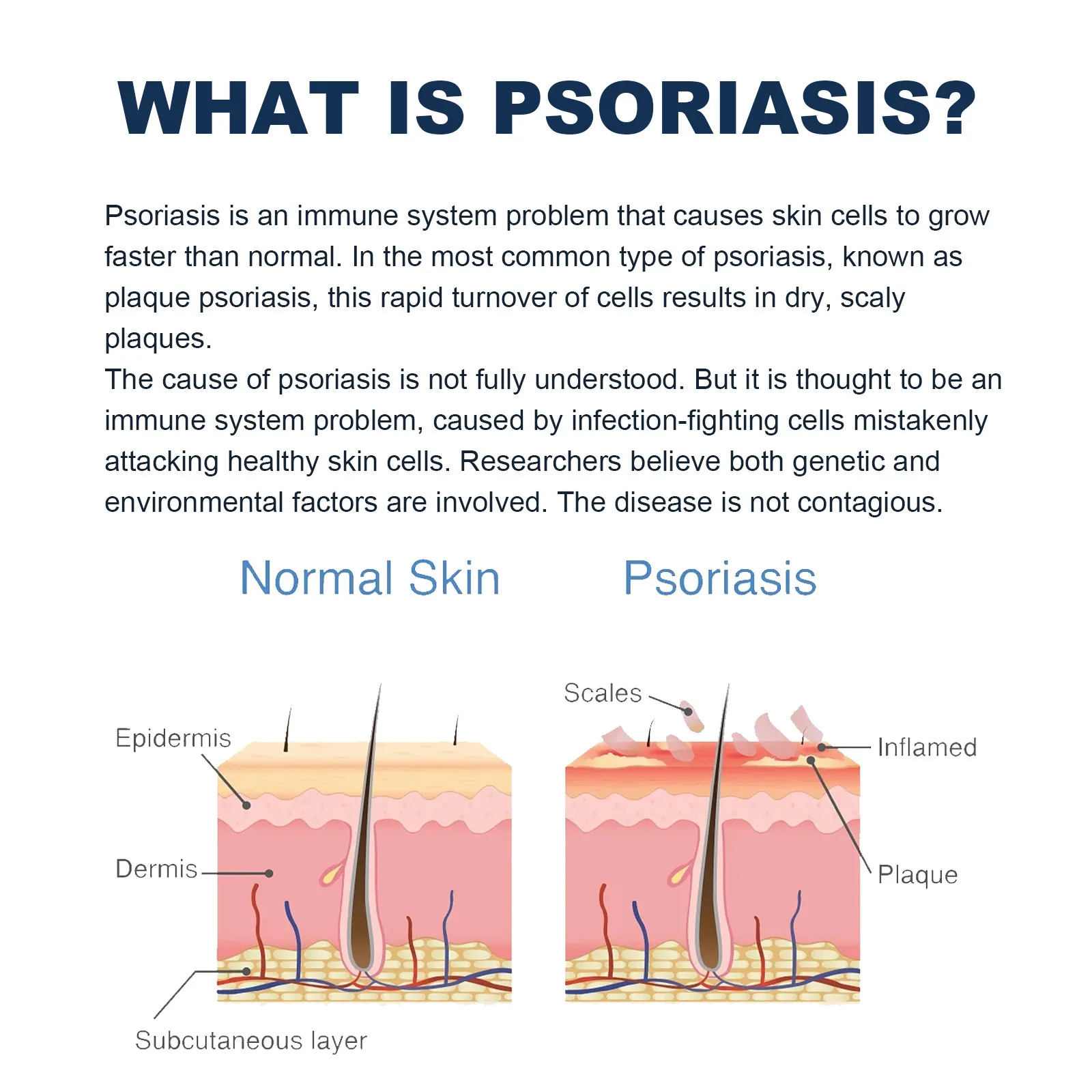 Hand Foot Scalp Eczema Tinea Antiitch Rash Urticaria Desquamation