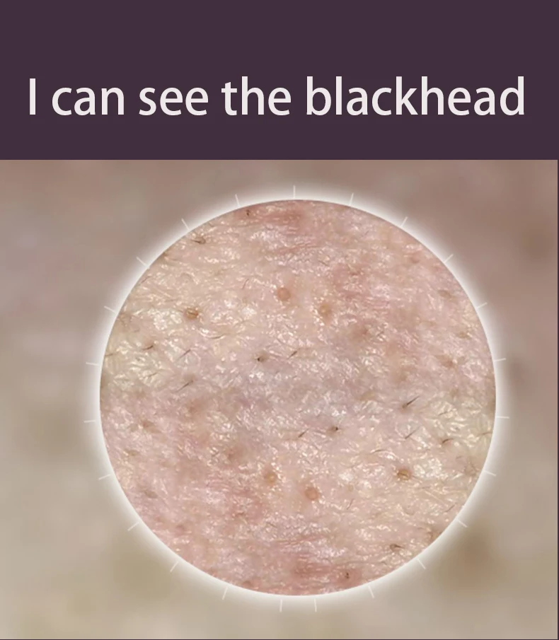 blackhead removal 10