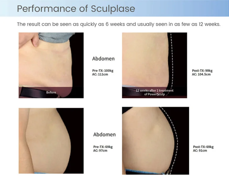 Laser beauty equipment 1060nm diode lipo laser fat removal body sculpting machine