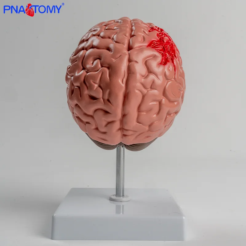 Pvc Brain PVC Brain Anatomical Model Cerebral Hemorrhage and Arteriovenous ...