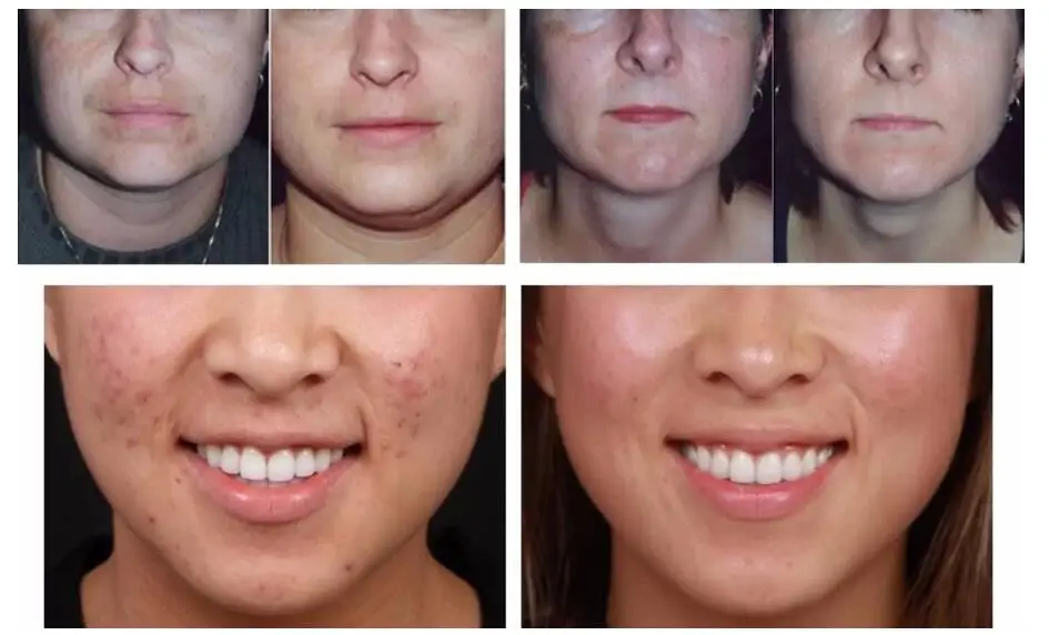 dermabrasion4.jpg