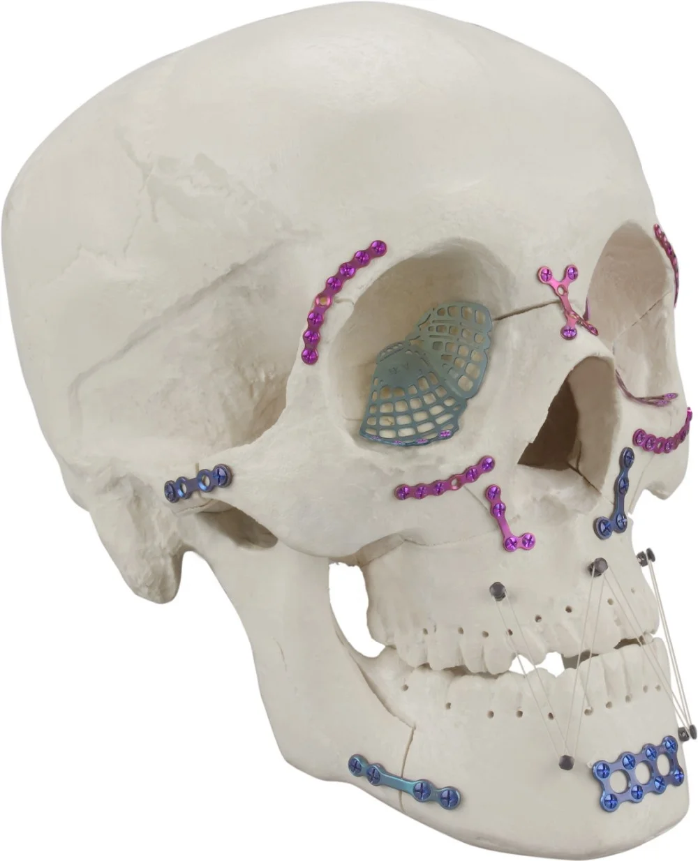 Титановая пластина. Титановые пластины ЧЛХ. Пластины Maxillofacial Plate. Челюстно-лицевой остеосинтез. Титановые пластины для челюсти.