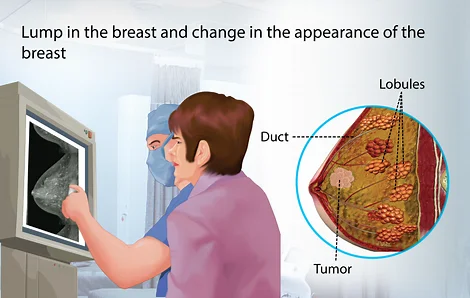 what is the breast cancer symptoms?