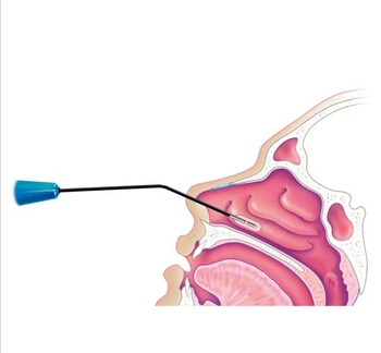 Medical Device for Turbinate Surgery, View medical device, MECHAN ...