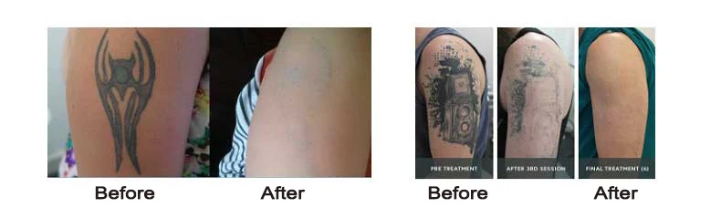 tattoo removal.jpg