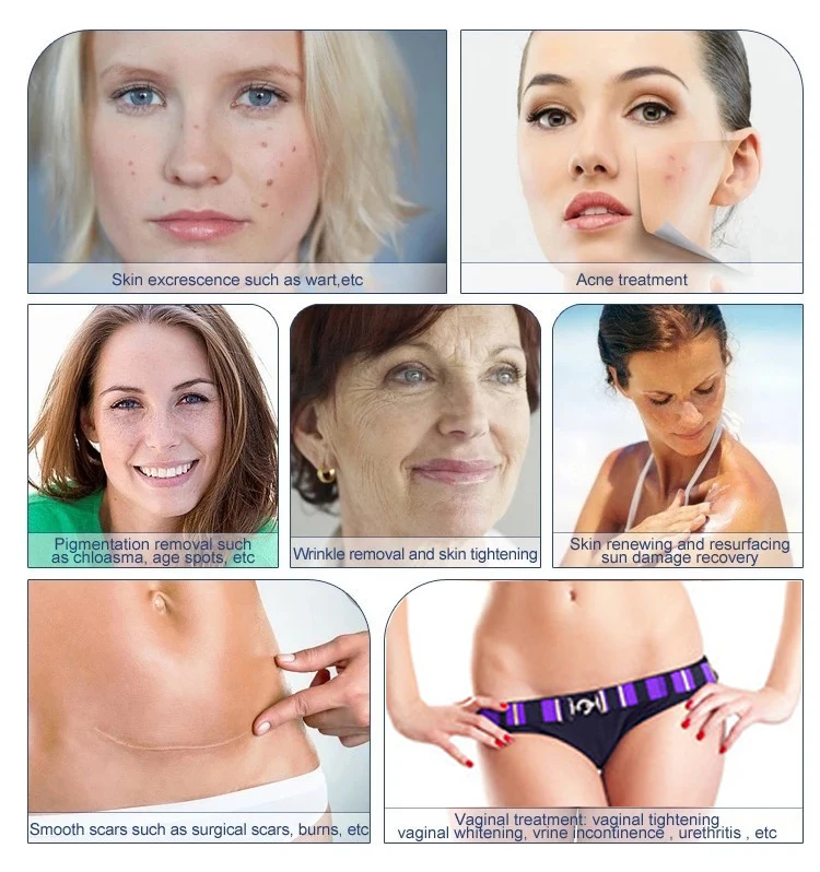 co2 plus fractional laser