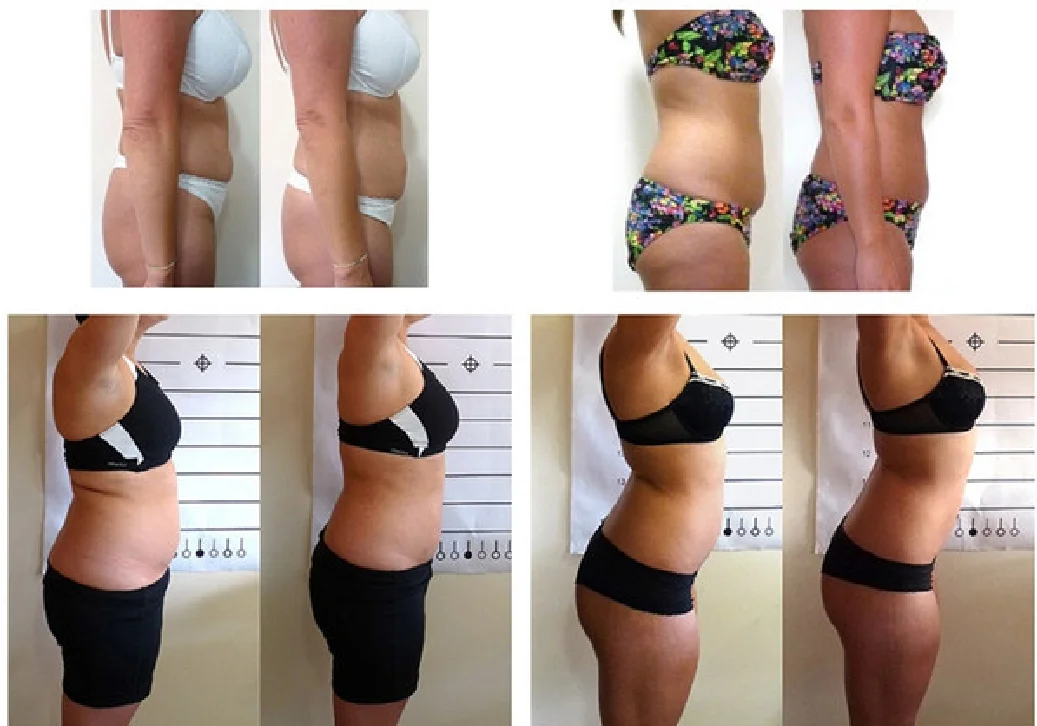 Surgery Without The Scalpel - No Lipo Lipo DVD Trims Inches and Sculpts Body Wit