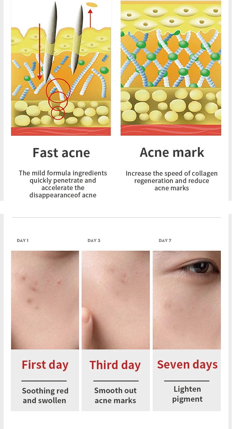 Private Label Korean Acne Scar Removal Face Repair Herbal Oil Control Lightening Whitening Acne