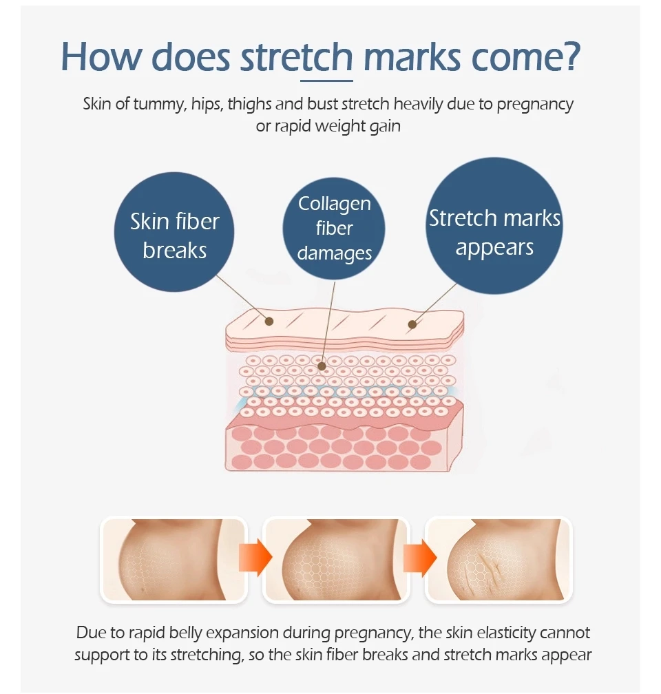 stretch marks removal-12.jpg