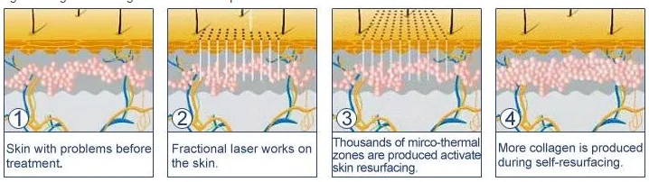 10600nm European star fotona 4d pro face facial anti-aging firming lifting wrinkles women private postpartum repair CO2 laser