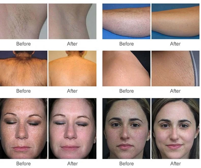 808nm Diode Laser Hair Removal Machine for Spa and Salon Use Ice Laser Depilation Equipment 808nm Hair Removal Machine