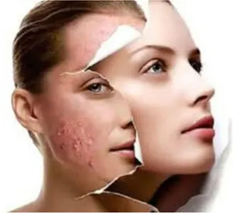 acne care skin treatment 6.jpg