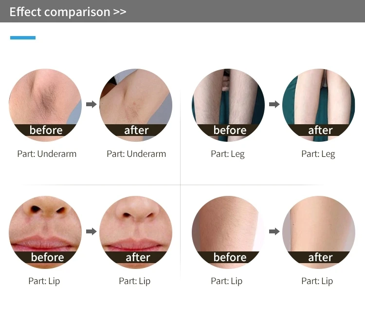 New design for wholesales 808 Professional 808nm diode laser hair