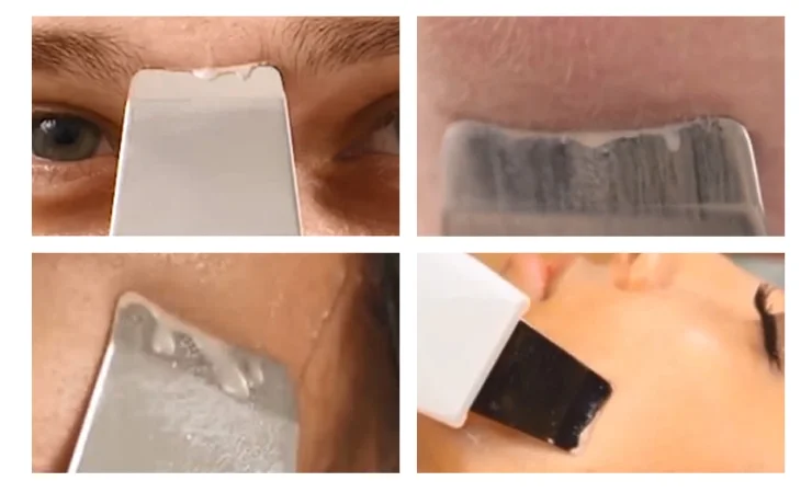 amazon best beauty facial face scrubber skin black head removal home use facial skin scrubber 2020 anlan 3 in 1 skin scrubber  