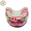 Resin Maxillary Implant model for Practice Dental Teeth Model