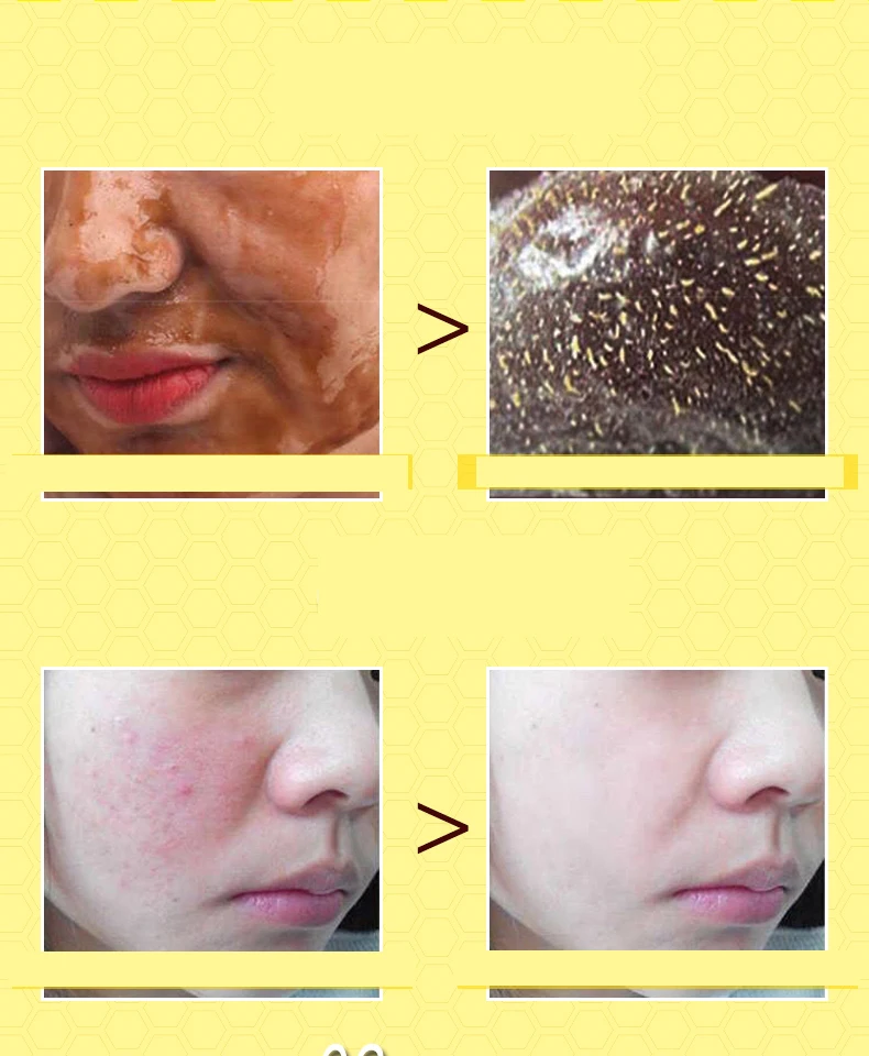 Honey Tearing Mask Peel Mask Oil Control Blackhead Remover Peel Off Dead Skin Clean Pores Shrink