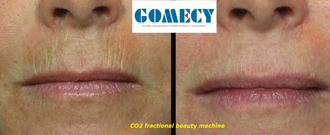 RF co2 laser smoke wrinkle.jpg