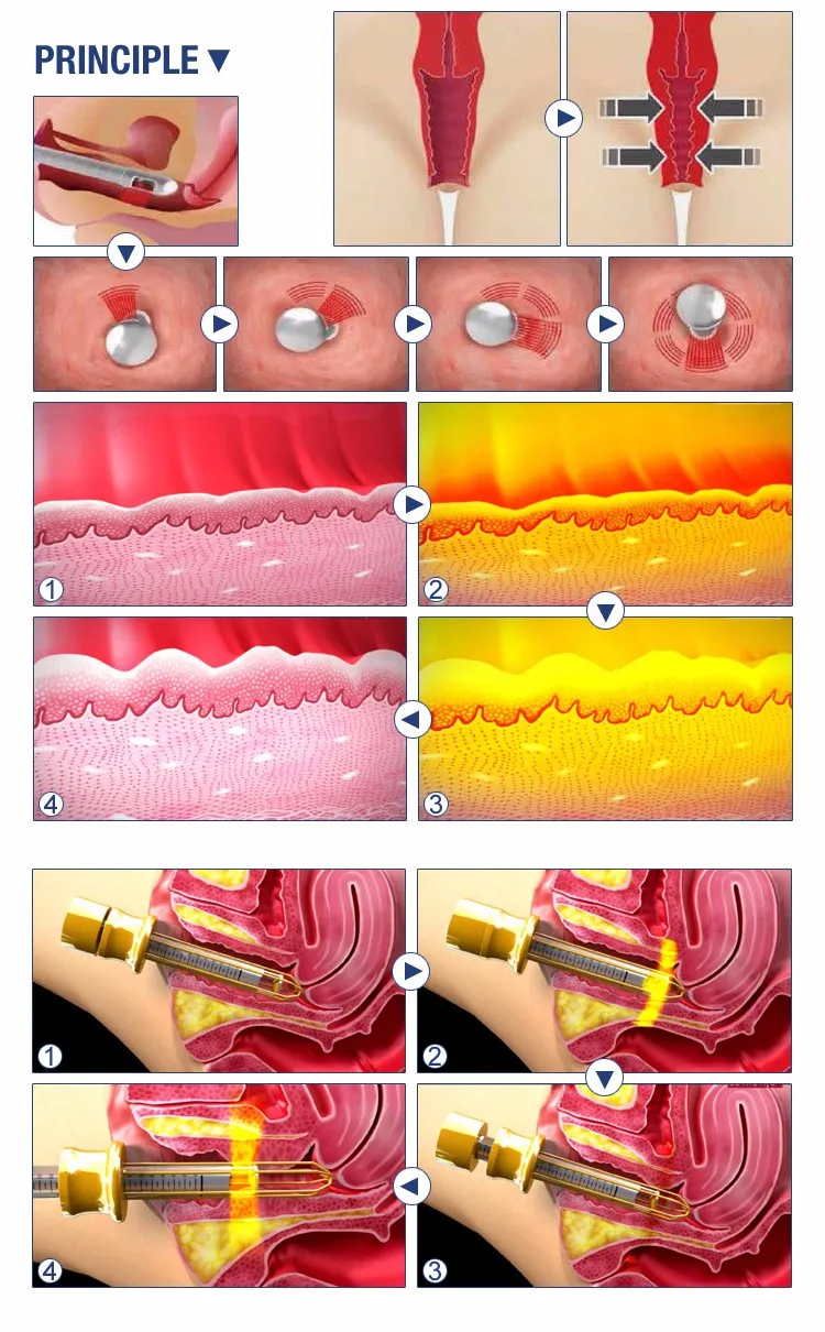 vaginal hifu1.jpg