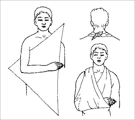 肩关节三角巾固定法图片
