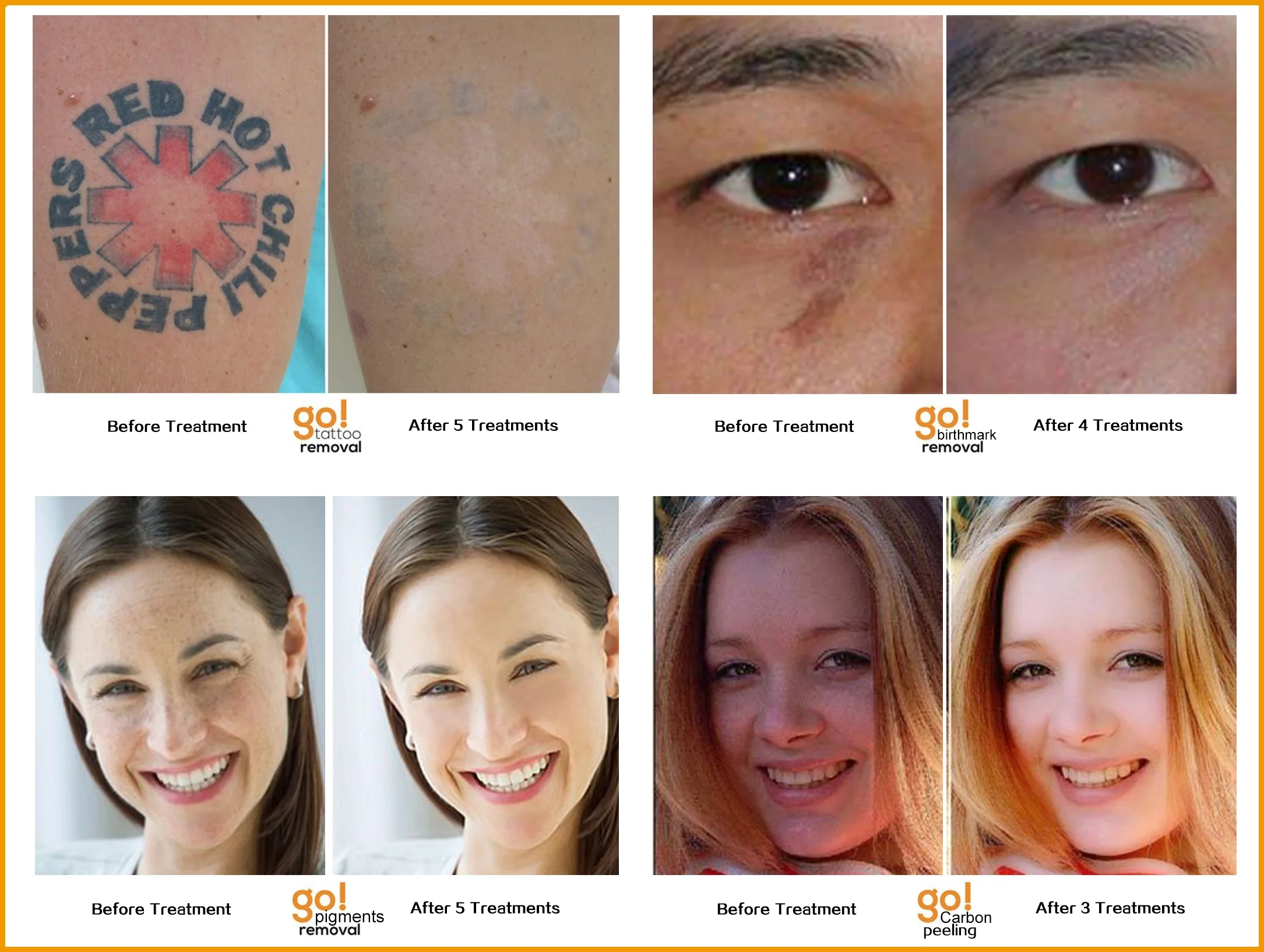 Yag Laser Type Q-Switch tattoo & birth mark removal surgical equipment