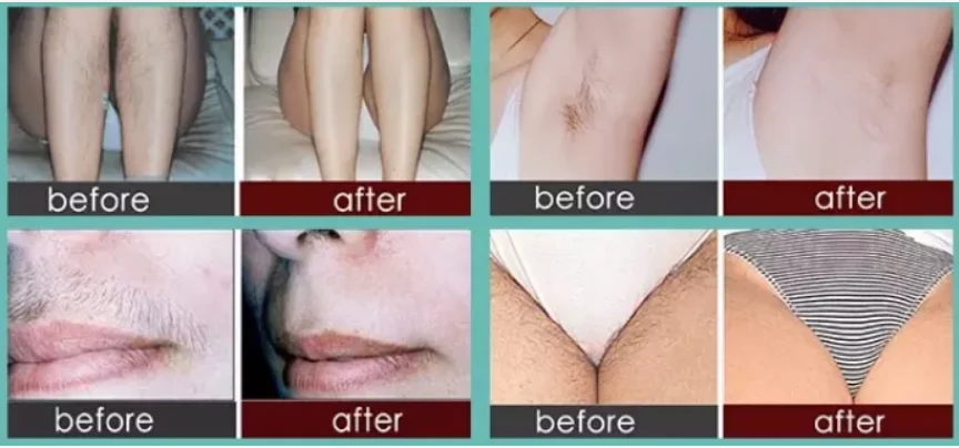 mini 808nm hair removal home use easy to operate, no pain hair removal permanently beijing Anybeauty