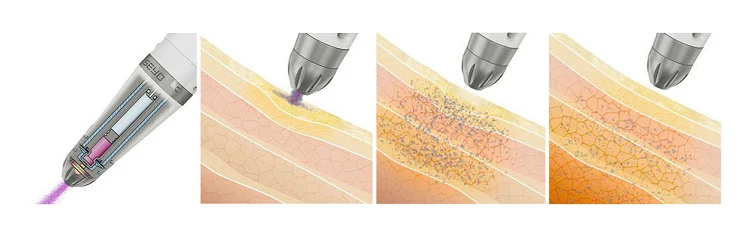face lift machine skin tightening