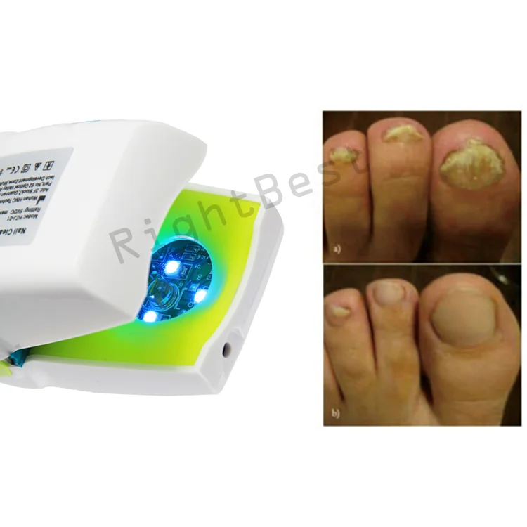 Nail Fungus Laser Foot Fungus Treatment Therapy Device Instrument ...