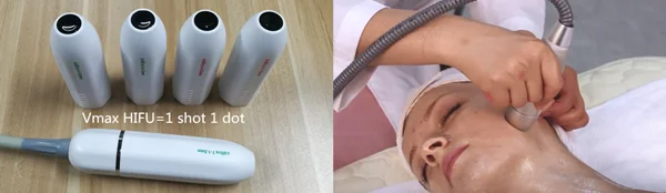 Vmax hifu