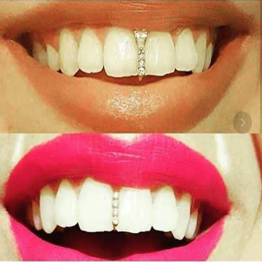 Украшение зубов скайсами