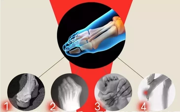 toe corrector (5).jpg