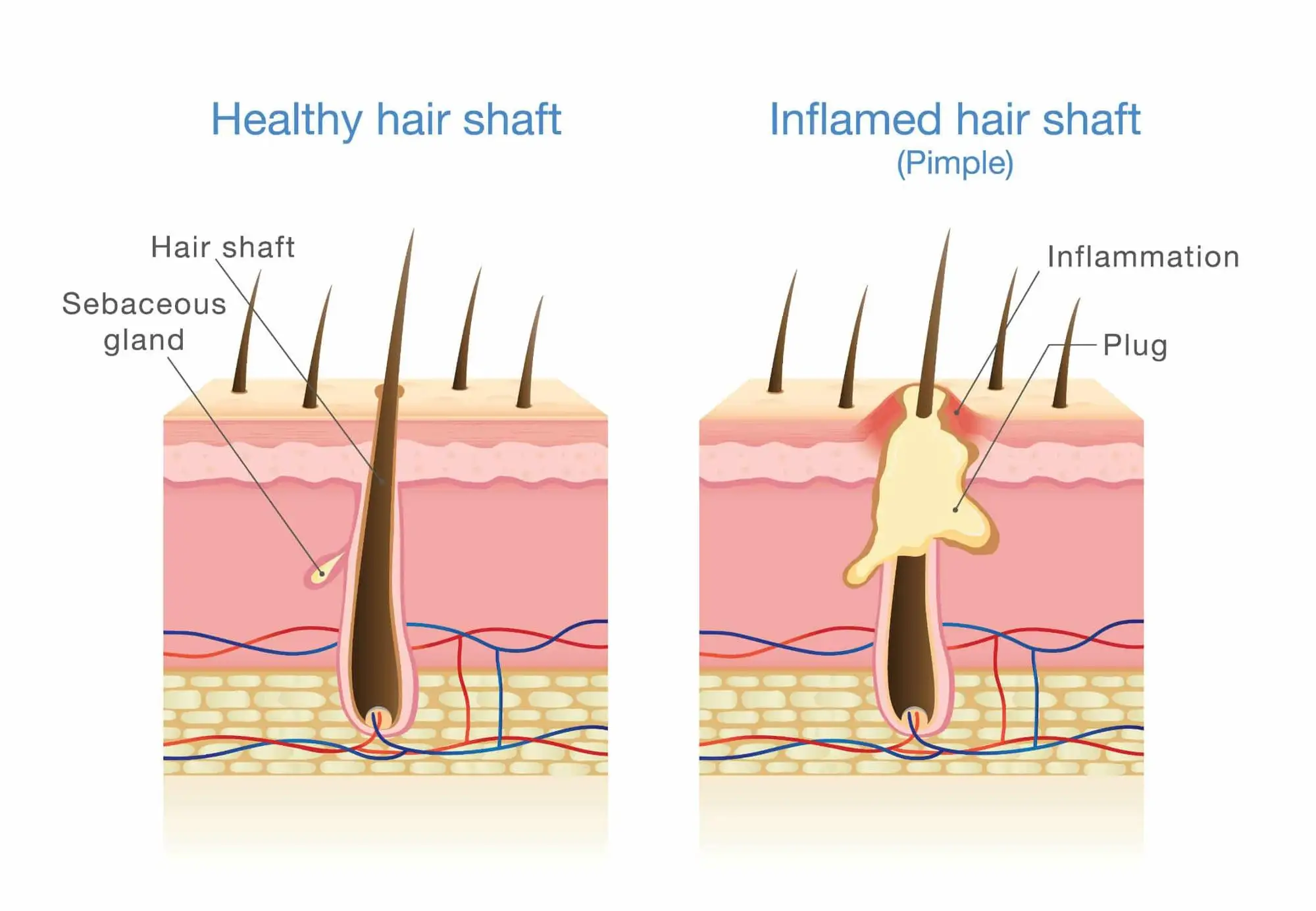 Microneedling Hair Loss Treatment Otesaly Vitamins Growth Factor Serum 