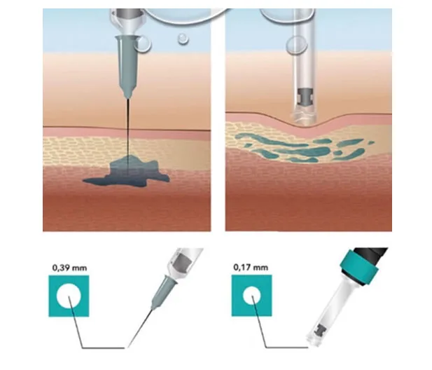 Skinject Hyaluronic Acid 0.5ml Ampoule For Mesotherapy Gun.jpg