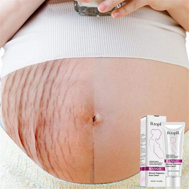 stretch marks cream (5).jpg