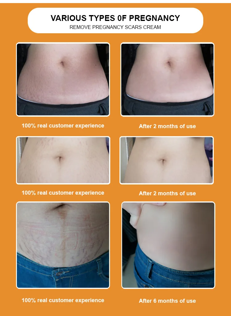 Snmlpm Daily Moisturizer Stretch Mark Cream Reduce And Fade Away Old Or