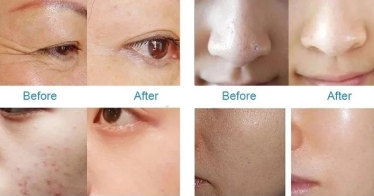 Korea Needle Free Skin Nutrient Water Ultrasonic Serum Dermaheal Mesotherapy Gun Machine