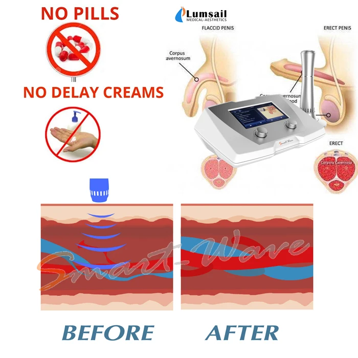 Unfocused BS-SWT2X ED shock wave ed therapy penis enlargement machine male