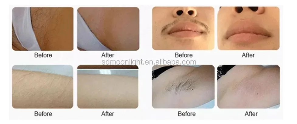 hair removal2