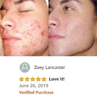 Anti-Acne Cream 6.jpg