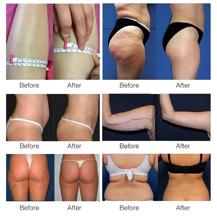 Newest 6 In 1 RF Cavitation Laser Lipolaser Body Slimming Weight Loss Machine