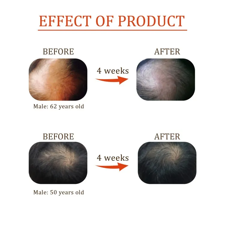 anti hair loss treatment