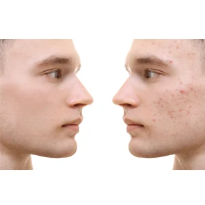 Anti-Acne Cream 2.jpg