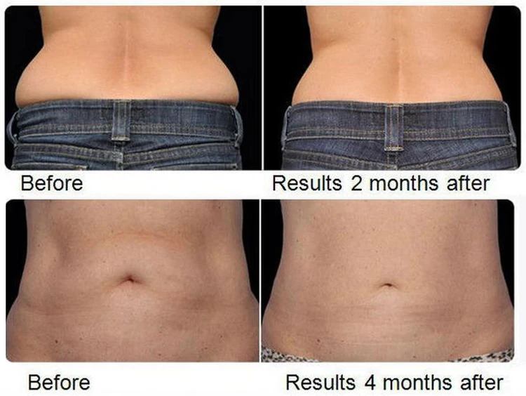 Lipo Laser Liposuction Remove Fat Cellulite Loss Weight Body Slimming